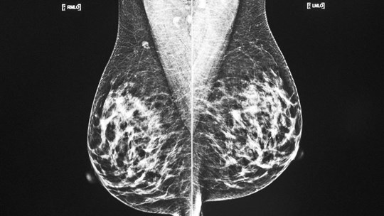 Une étude détaille l'association entre l'obésité et le cancer du sein