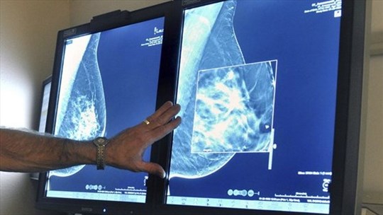Nouvel espoir face au cancer du sein triple négatif