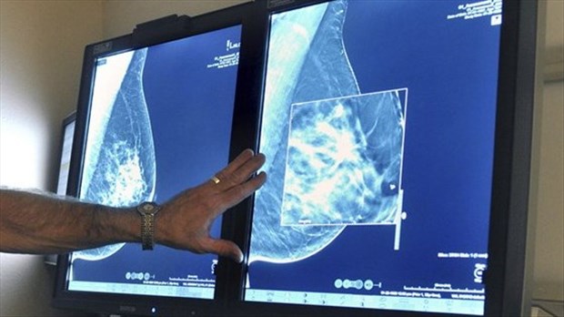 Nouvel espoir face au cancer du sein triple négatif